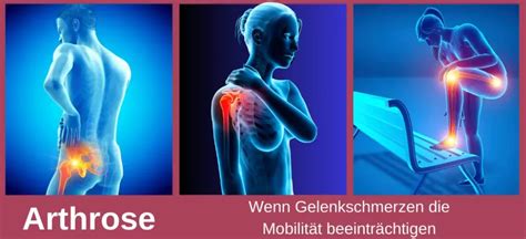 gdb tabelle bei arthrose